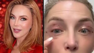 blefaroplastia Laura Flores